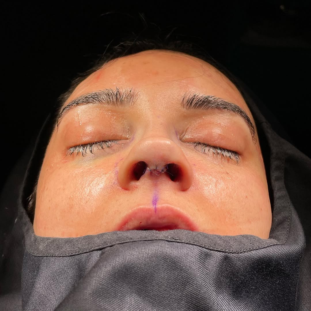 ultrasonic-rhinoplasty-9