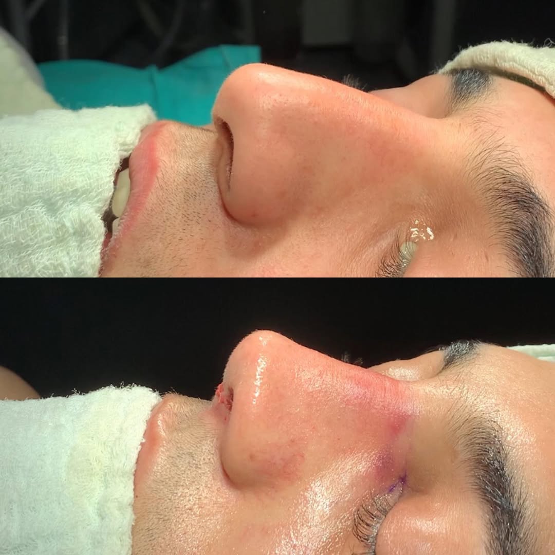 ultrasonic-rhinoplasty-3