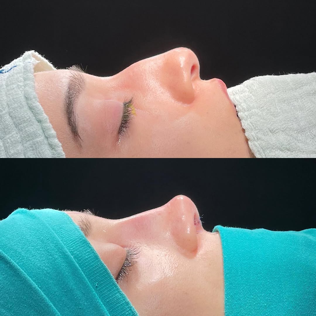 ultrasonic-rhinoplasty-4