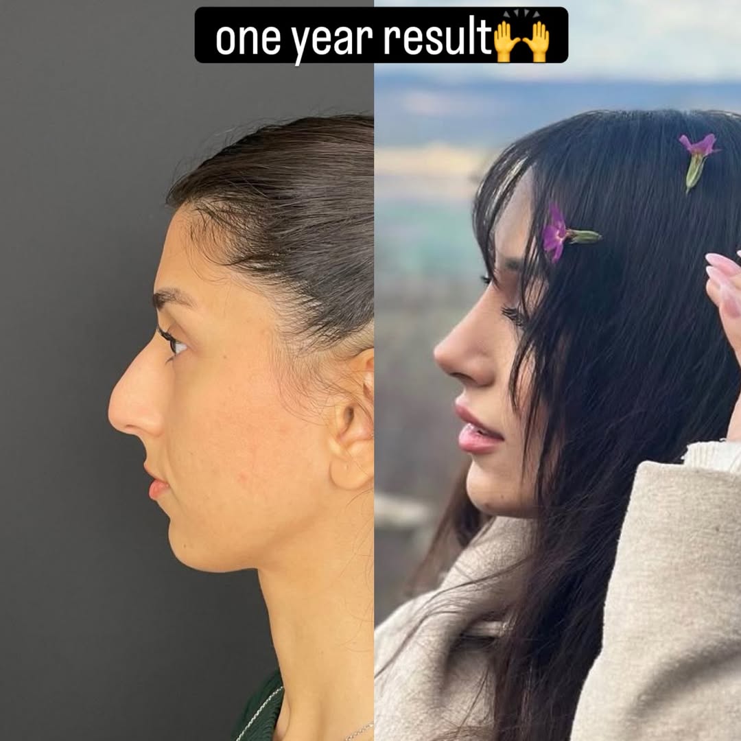 nose job in turkey, antalya-1