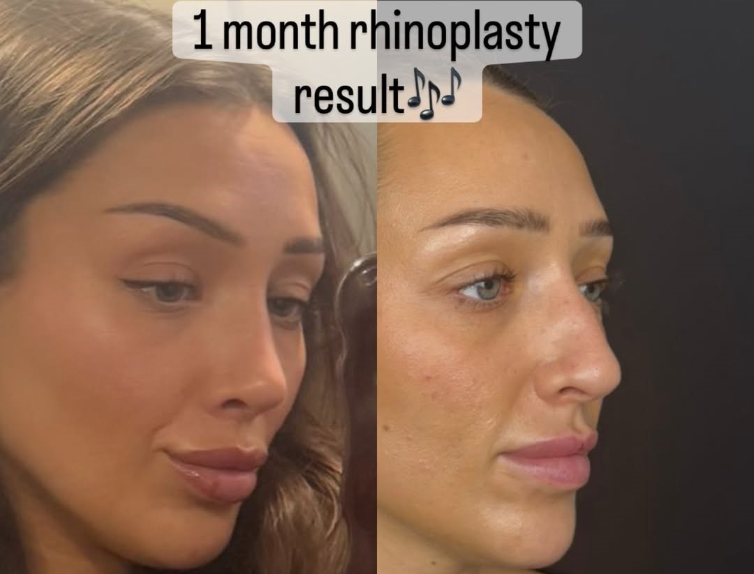 Things to Avoid After Rhinoplasty in the 1st Month