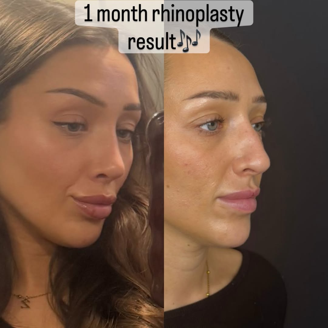 nose job in turkey, antalya-2