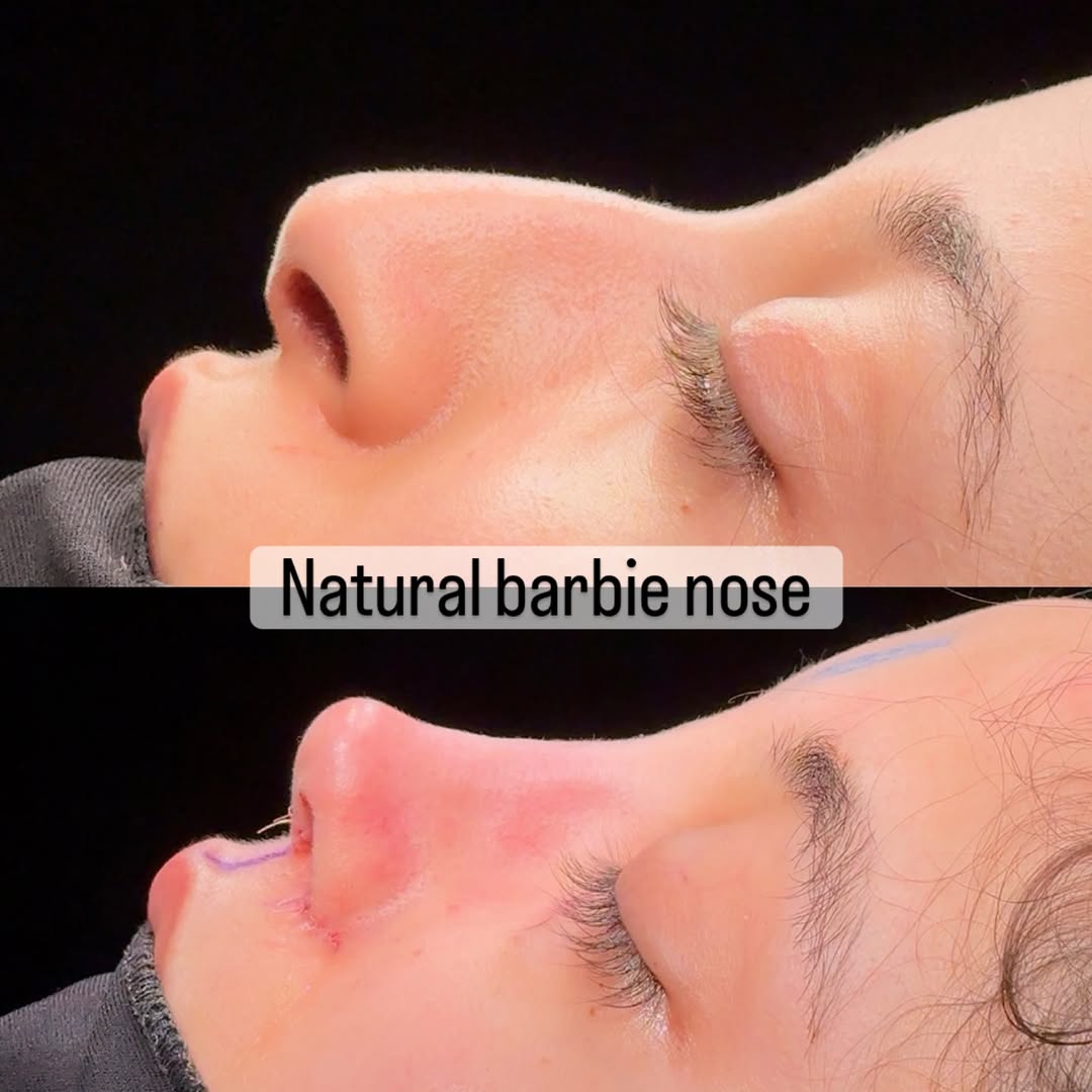 nose job in turkey, antalya-3