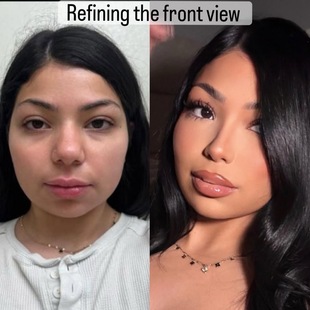 nose job in turkey, antalya-4