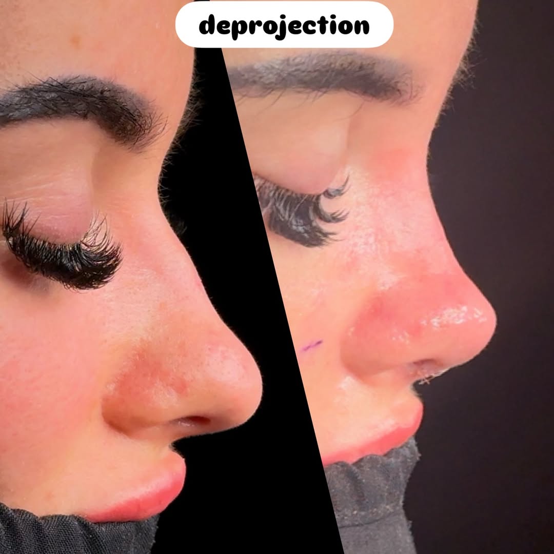 nose job in turkey, antalya-6