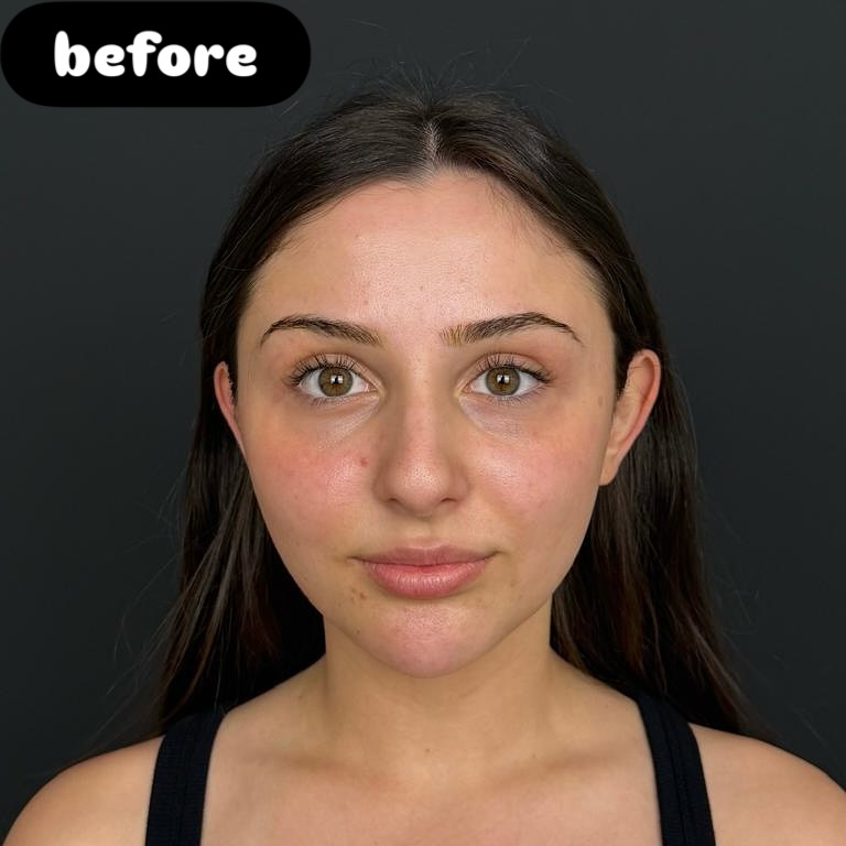 Nose Job Turkey, Antalya before and after-11 Nose Job Turkey, Antalya before and after-11
