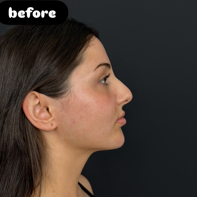 Nose Job Turkey, Antalya before and after-12 Nose Job Turkey, Antalya before and after-12