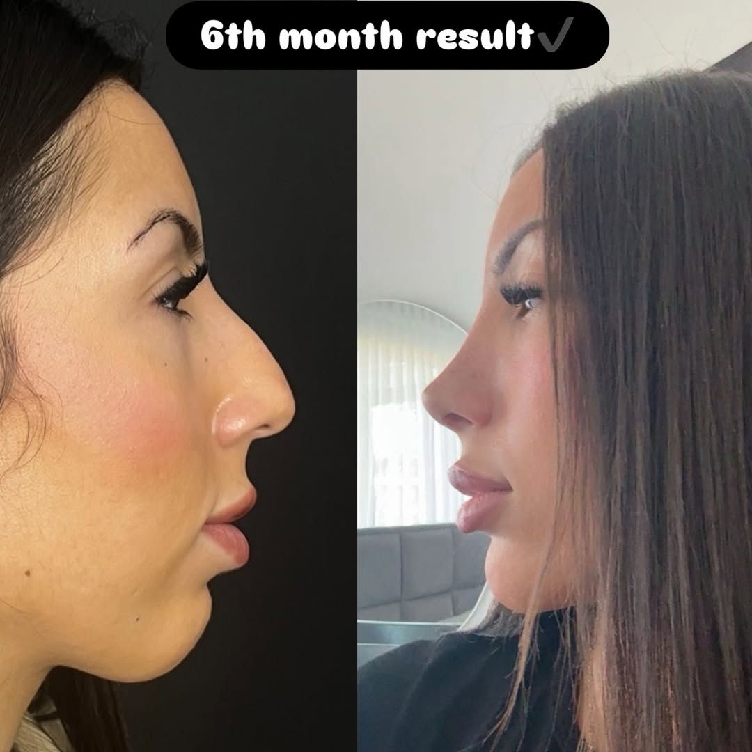 Nose Job Turkey, Antalya before and after-3