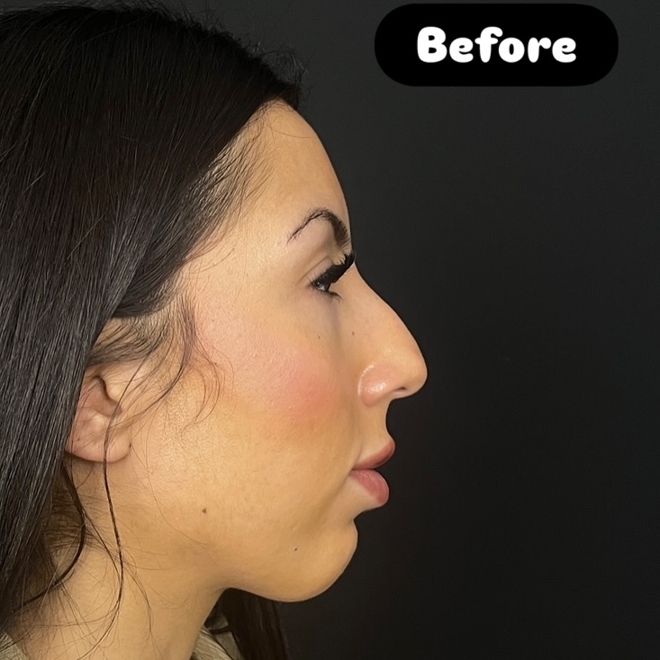 Nose Job Turkey, Antalya before and after-4