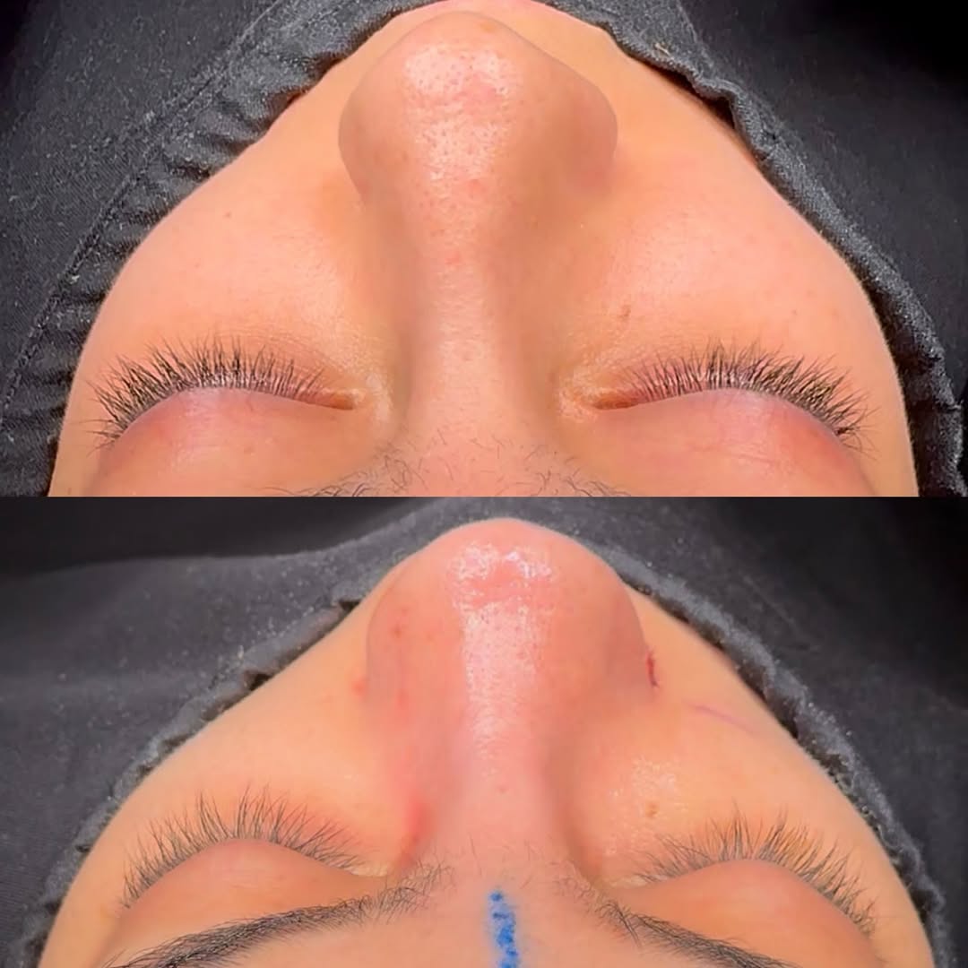 Nose Job Turkey, Antalya before and after-7