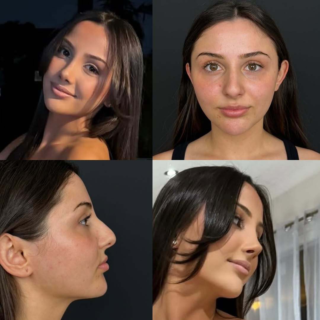 Nose Job Turkey, Antalya before and after-9 Nose Job Turkey, Antalya before and after-9