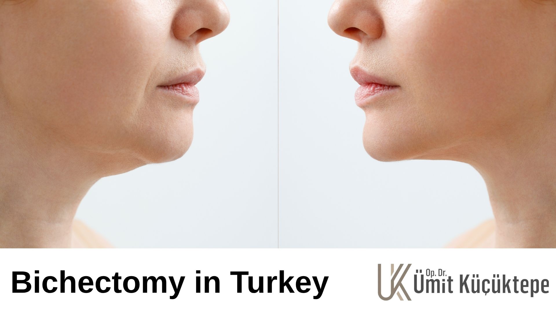 Buccal Fat Removal (Bichectomy) in Turkey, Antalya 