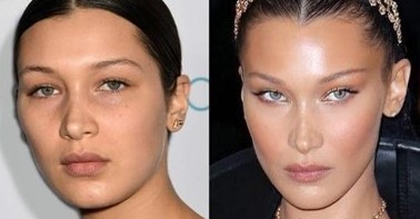 endoscopic-temporal-lift in turkey antalya