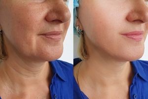 endoscopic-midface-lift-before-after-12