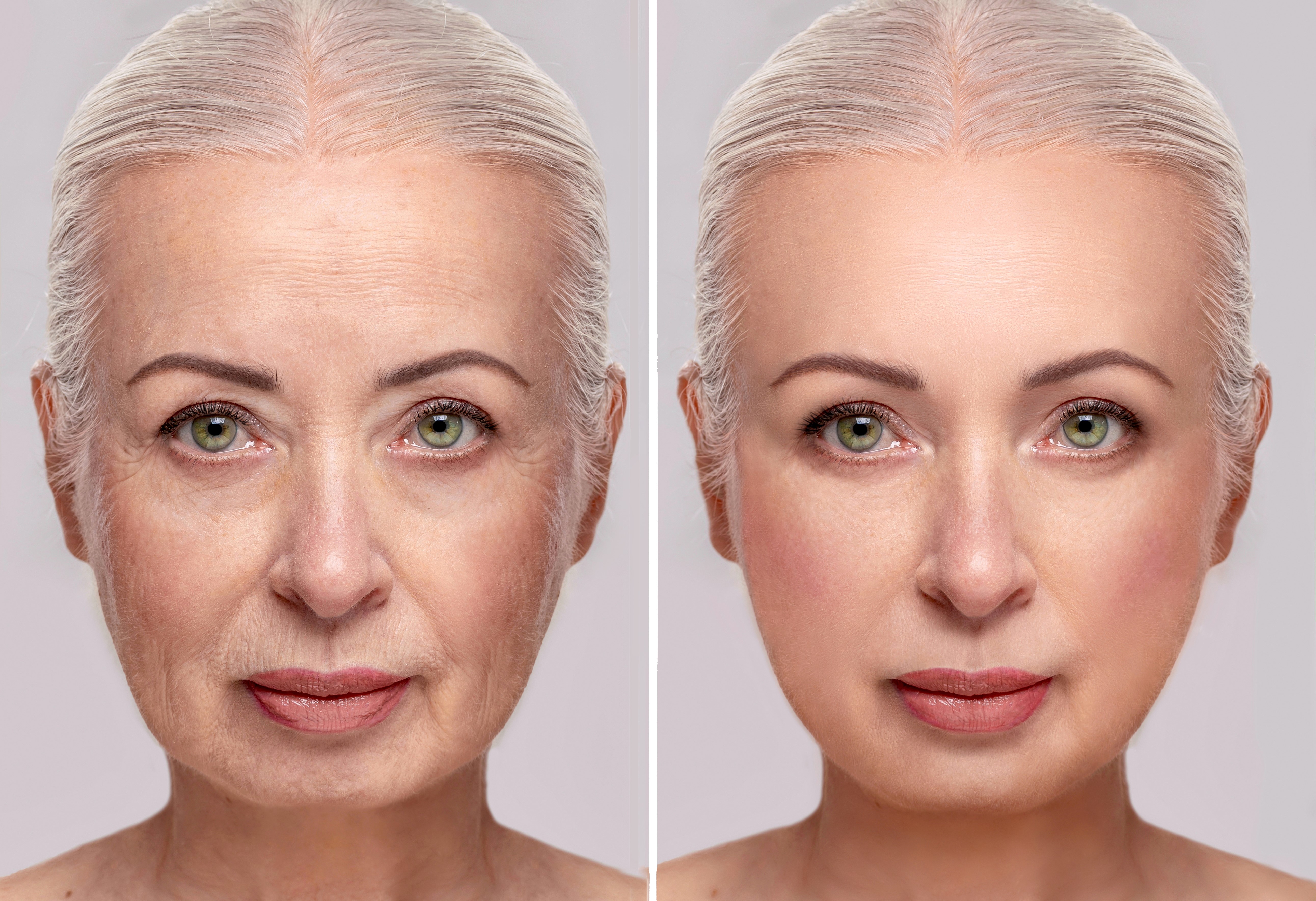 endoscopic-midface-lift-before-after-2