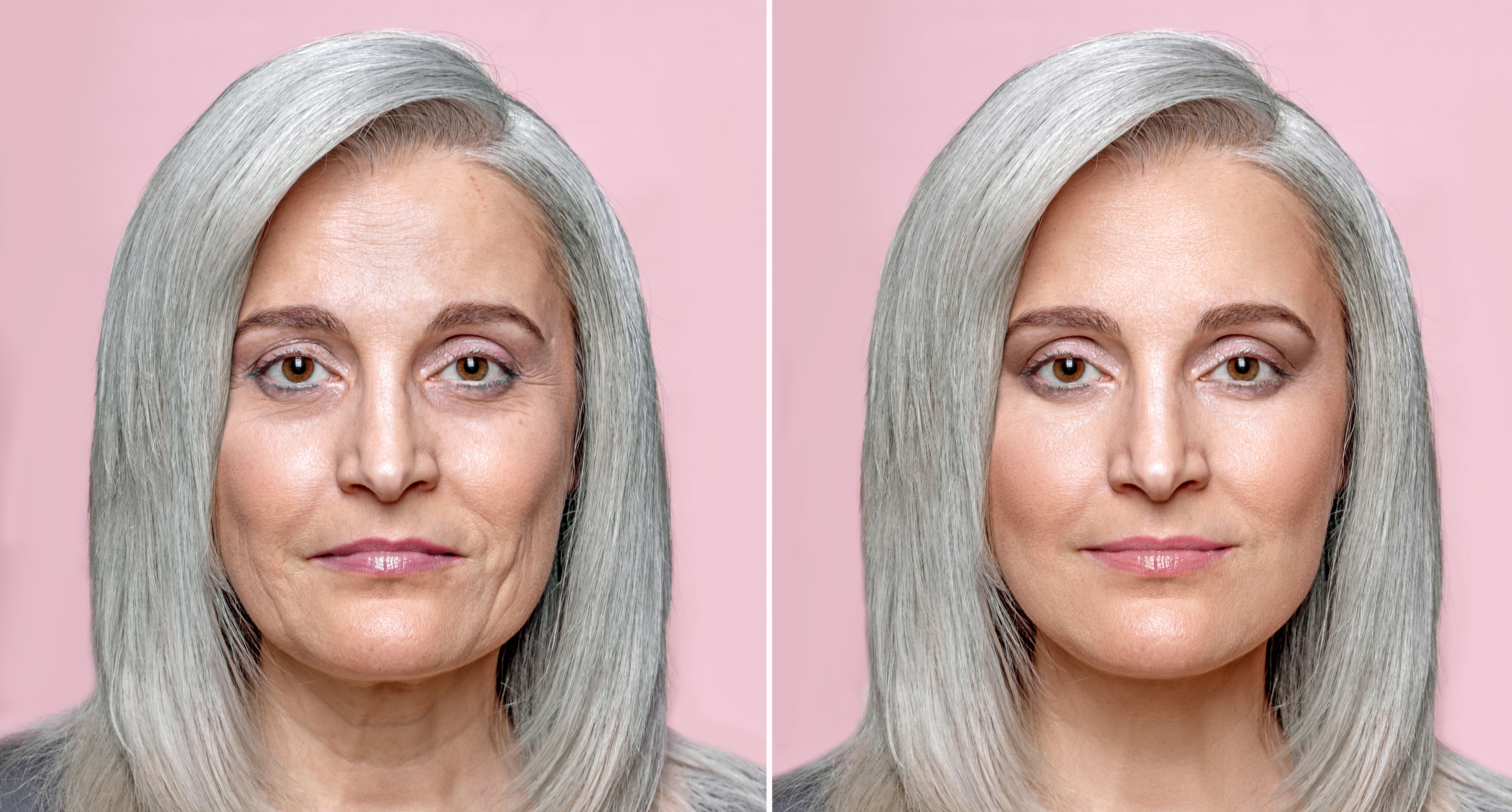 endoscopic-midface-lift-before-after-3